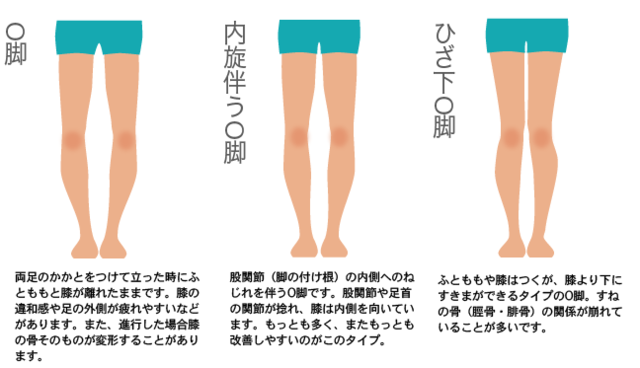 堺市 ｏ脚矯正 口コミで選ぶなら よしもと整体療術院