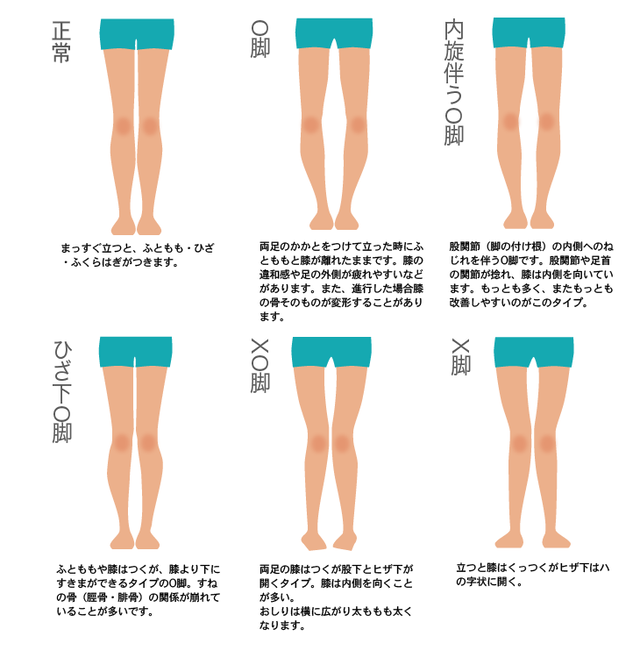 堺市 O脚矯正 よしもと整体療術院 ひざ下o脚 X脚 ｘｏ脚