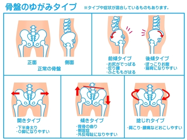 堺市 骨盤矯正 よしもと整体療術院 産後の骨盤 腰痛に
