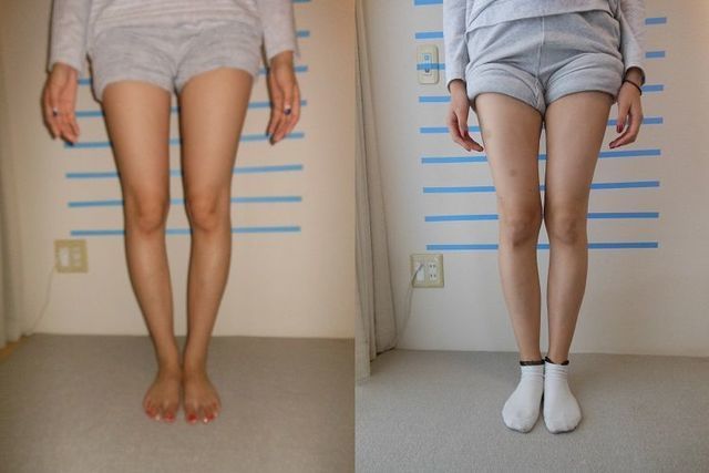 実績 Before/After(O脚X脚矯正、美脚ダイエット)